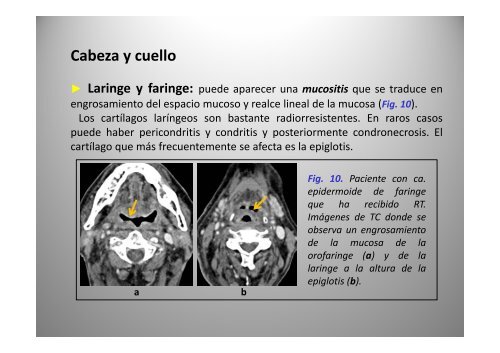 C bi d i Cambios secundarios a radioterapia: radioterapia: