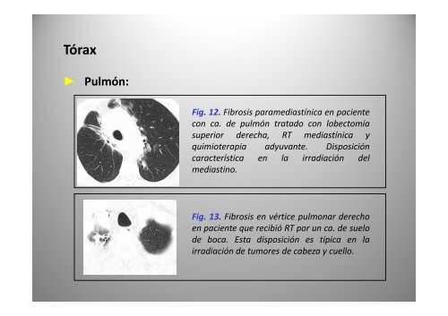 C bi d i Cambios secundarios a radioterapia: radioterapia: