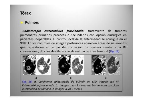 C bi d i Cambios secundarios a radioterapia: radioterapia: