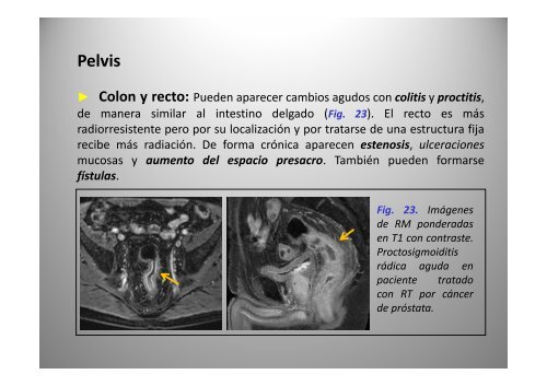 C bi d i Cambios secundarios a radioterapia: radioterapia: