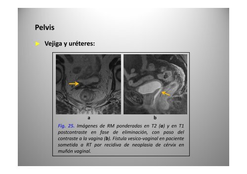 C bi d i Cambios secundarios a radioterapia: radioterapia: