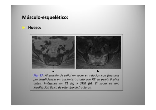 C bi d i Cambios secundarios a radioterapia: radioterapia: