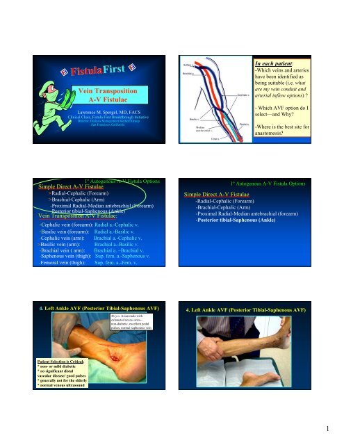 AV Fistula Vein Transpositions