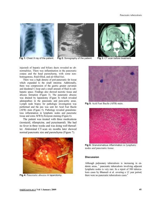 Pancreatic Tuberculosis: A Case Report - IAGH