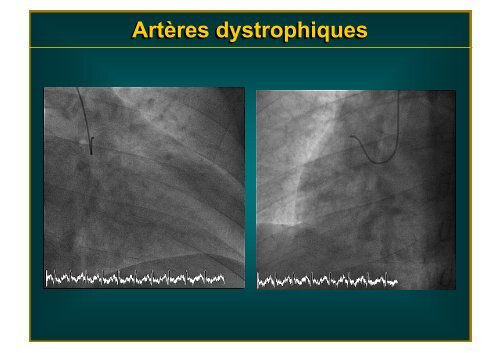 Artères dystrophiques - Mediathèque du congrès de High Tech Cardio