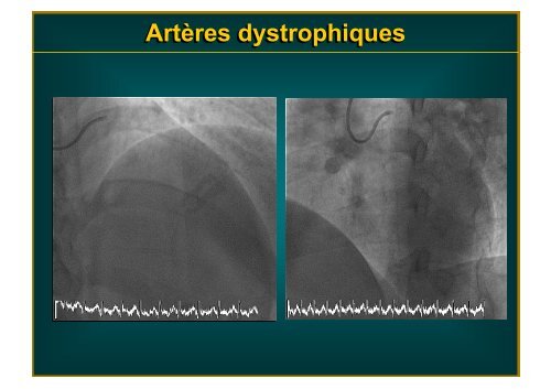 Artères dystrophiques - Mediathèque du congrès de High Tech Cardio