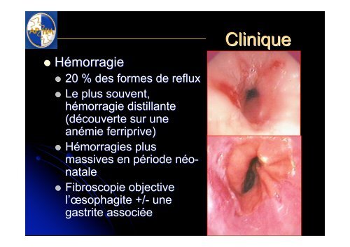 Reflux gastro-oesophagien - SOFOP