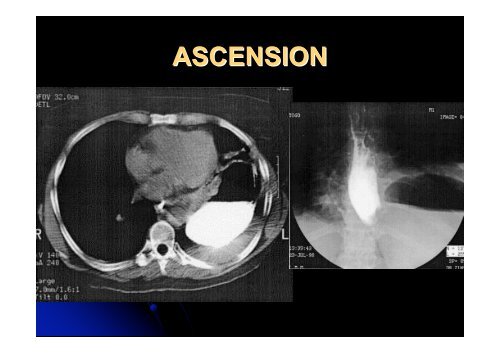 Reflux gastro-oesophagien - SOFOP