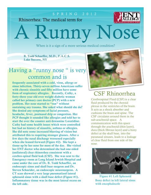 CSF rhinorrhea Newsletter B - ENT & Allergy Associates