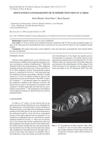 SPONTANEOUS CONSOLIDATION OF SCAPHOID NONUNION IN ...