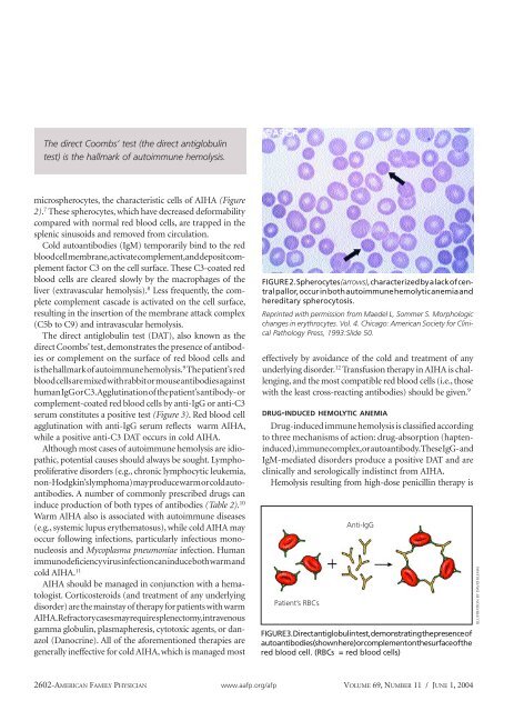 Hemolytic Anemia