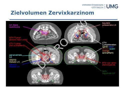 Zielvolumendefinition beim Zervixkarzinom