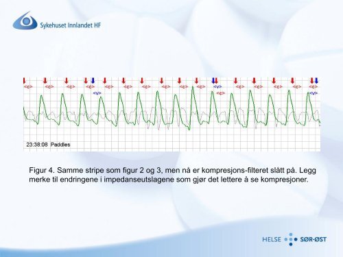 Larynxtube og larynxmaske: Alternativer for trenet personell - nakos