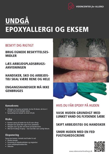 Opslag til arbejdspladsen om epoxyallergi og hÃ¥ndeksem