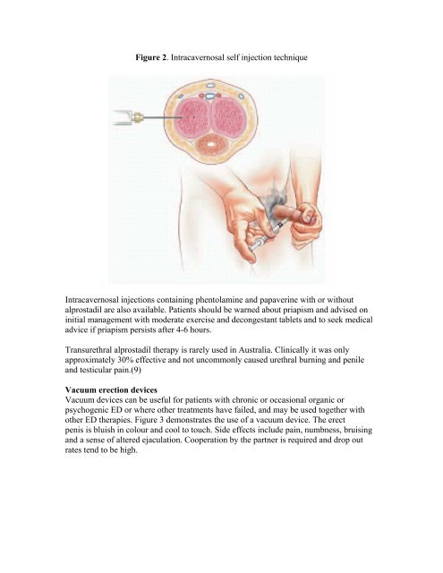 Erectile Dysfunction: A guide to diagnosis and management