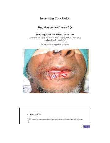 Interesting Case Series Dog Bite to the Lower Lip - ePlasty