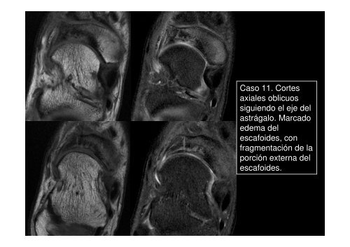 Caso 11. Cortes axiales oblicuos siguiendo el eje del astrágalo ...