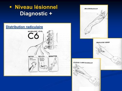 Explorations neuro-physiologiques radiculaires du bras douloureux