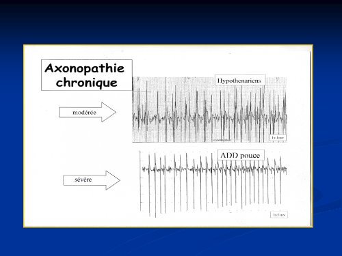 Explorations neuro-physiologiques radiculaires du bras douloureux