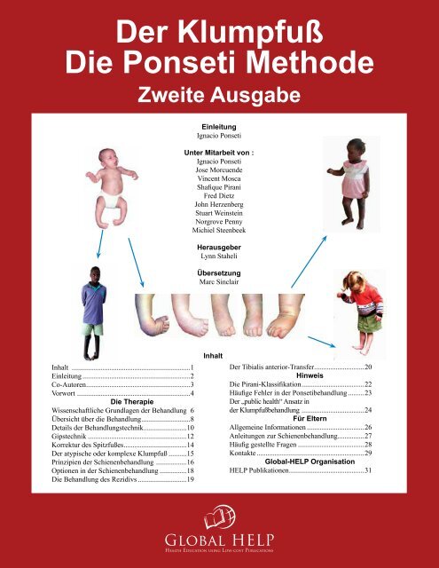 Clubfoot: Ponseti Management (2nd Edition) [German] - Global HELP