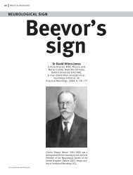 Beevor's sign NEUROLOGICAL SIGN - Practical Neurology