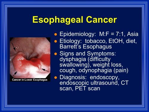 Esophageal And Gastric Cancer