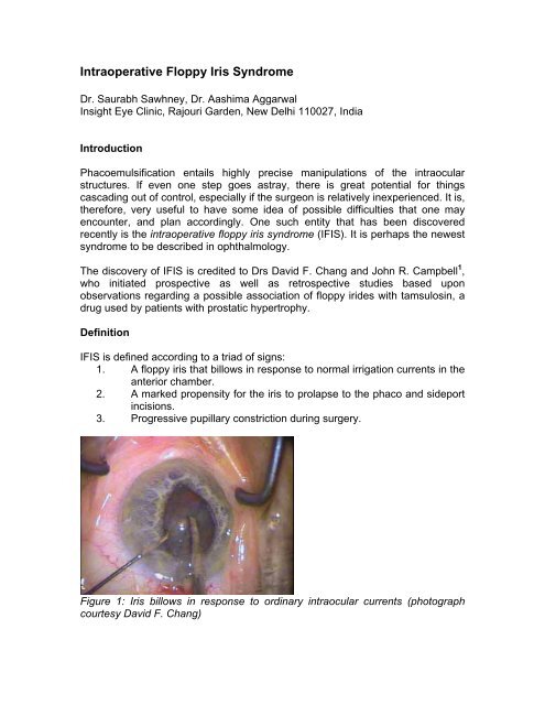 What Is Floppy Iris Syndrome?