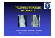 FRACTURES TRIPLANES DE CHEVILLE - ClubOrtho.fr