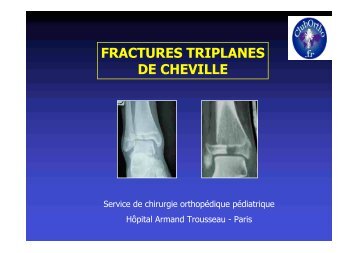 FRACTURES TRIPLANES DE CHEVILLE - ClubOrtho.fr