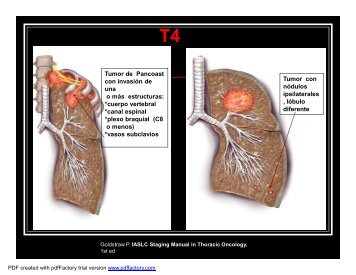 CÃ¡ncer de pulmÃ³n, screening, estatificaciÃ³n - SMIBA