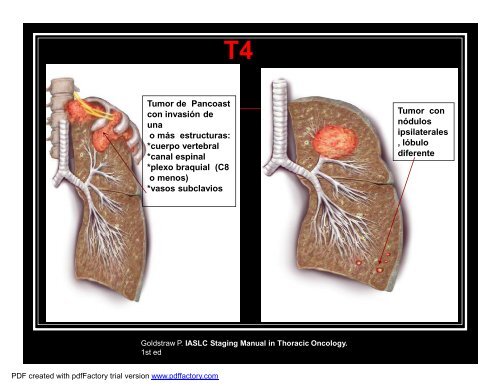 CÃ¡ncer de pulmÃ³n, screening, estatificaciÃ³n - SMIBA