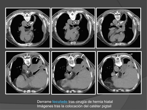 INDICACIONES DEL DRENAJE PLEURAL guiado por técnicas de ...