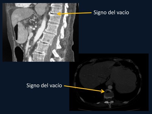 SIGNO DEL VACÍO DISCAL - Congreso SORDIC