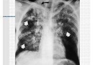Diagnostic de la Tuberculose pulmonaire - Association Anfas