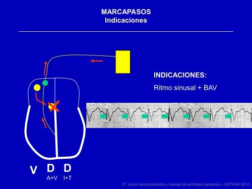 Ritmos lentos y marcapasos - cardiomil.com.uy