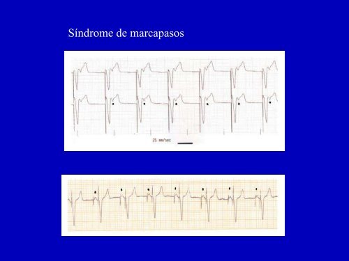 Ritmos lentos y marcapasos - cardiomil.com.uy