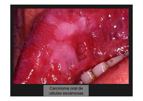 Curso Diagnóstico precoz del cáncer oral.