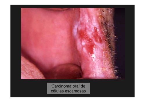 Curso Diagnóstico precoz del cáncer oral.