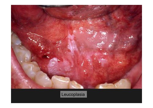 Curso Diagnóstico precoz del cáncer oral.