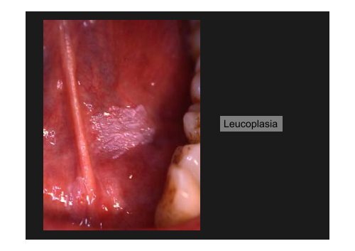 Curso Diagnóstico precoz del cáncer oral.