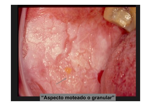 Curso Diagnóstico precoz del cáncer oral.