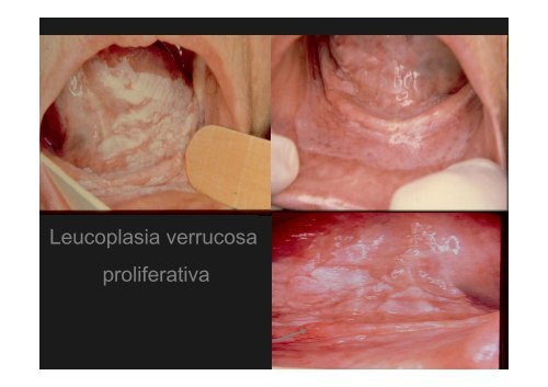 Curso Diagnóstico precoz del cáncer oral.