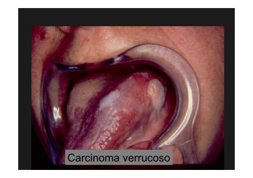 Curso Diagnóstico precoz del cáncer oral.