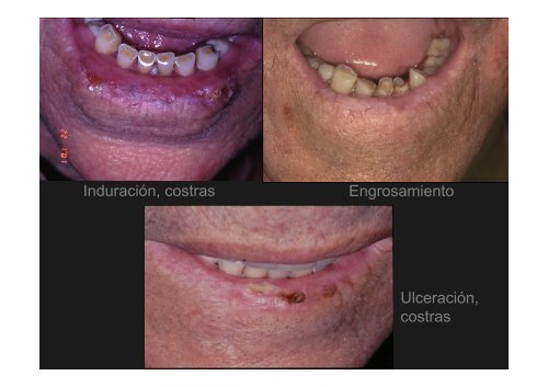 Curso Diagnóstico precoz del cáncer oral.