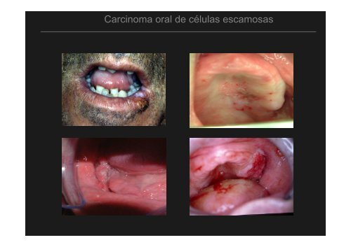 Curso Diagnóstico precoz del cáncer oral.