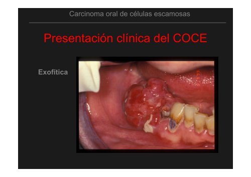 Curso Diagnóstico precoz del cáncer oral.