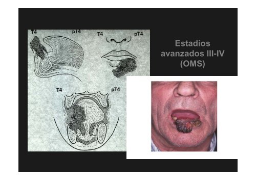 Curso Diagnóstico precoz del cáncer oral.