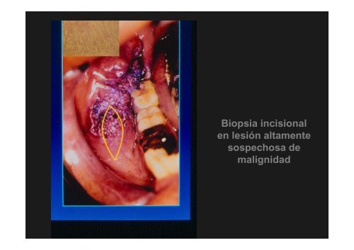 Curso Diagnóstico precoz del cáncer oral.