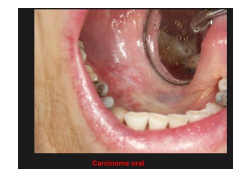 Curso Diagnóstico precoz del cáncer oral.