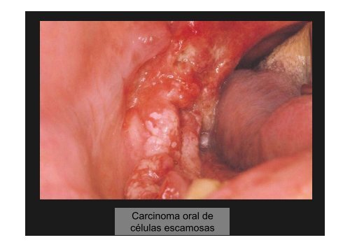 Curso Diagnóstico precoz del cáncer oral.